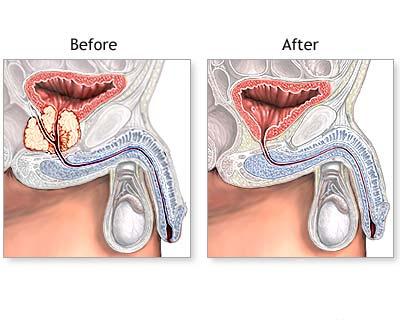 reduce adenomul de prostată